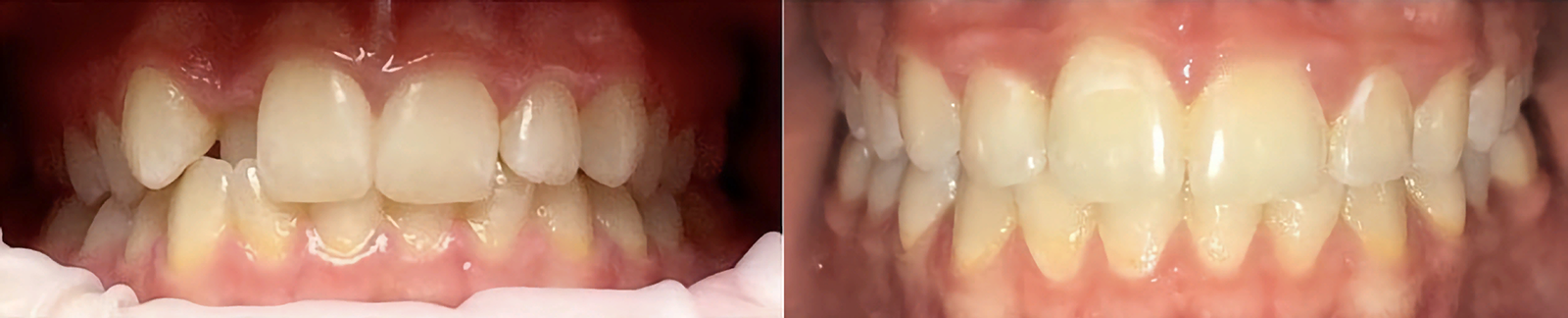 Лечение периостита Томск Корейский стоматология денталия томск на иркутском телефон